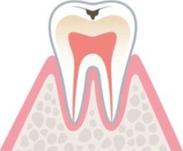 歯の表面（エナメル質）の限られた狭い範囲に穴ができている状態