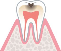 むし歯菌が象牙質の中（歯の内部）に広がった状態