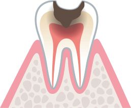 むし歯が神経（歯髄）まで進んでいる状態