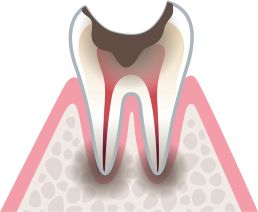 歯冠部（歯ぐき〈歯肉〉から上の見える部分）がほとんど崩壊し、歯根だけ残った状態
