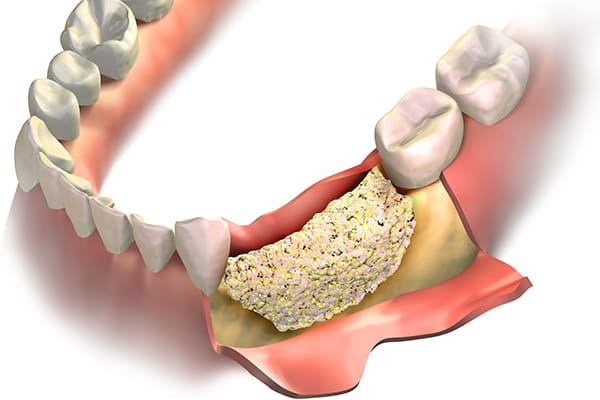 GBR・骨誘導再生法
