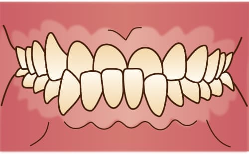 受け口・下顎前突・しゃくれ・反対咬