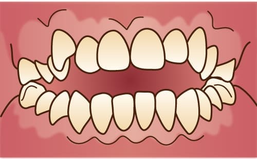 開咬・オープンバイト