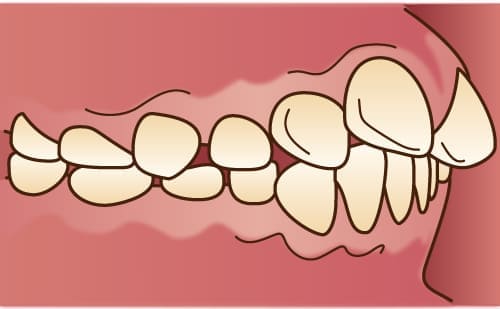 出っ歯・上顎前突