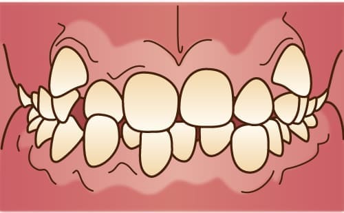 叢生・乱杭歯・八重歯