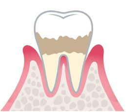 軽度歯周炎