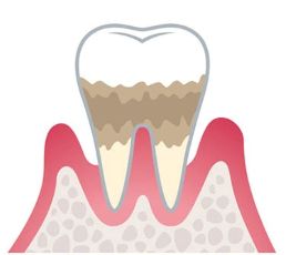 中度歯周炎