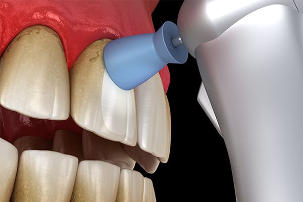 PMTC（衛生士による歯のクリーニング）