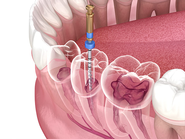 根管治療について