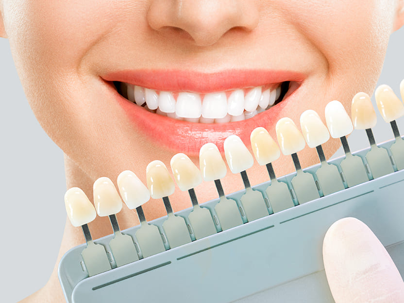 医療ホワイトニングってなに？