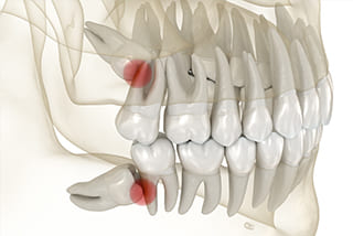 口腔外科・親知らずの抜歯