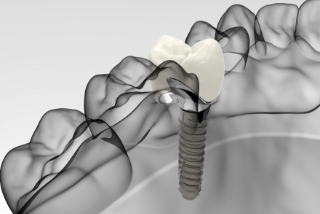 自分の歯のように噛めて美しい歯に・インプラント