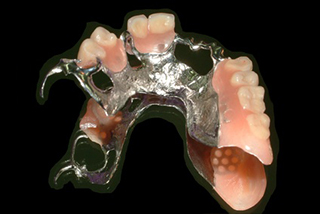 ピッタリ合う痛くない噛める義歯・入れ歯